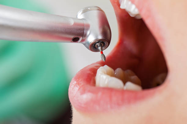 Best Emergency Dental Extractions in Red Oak, IA